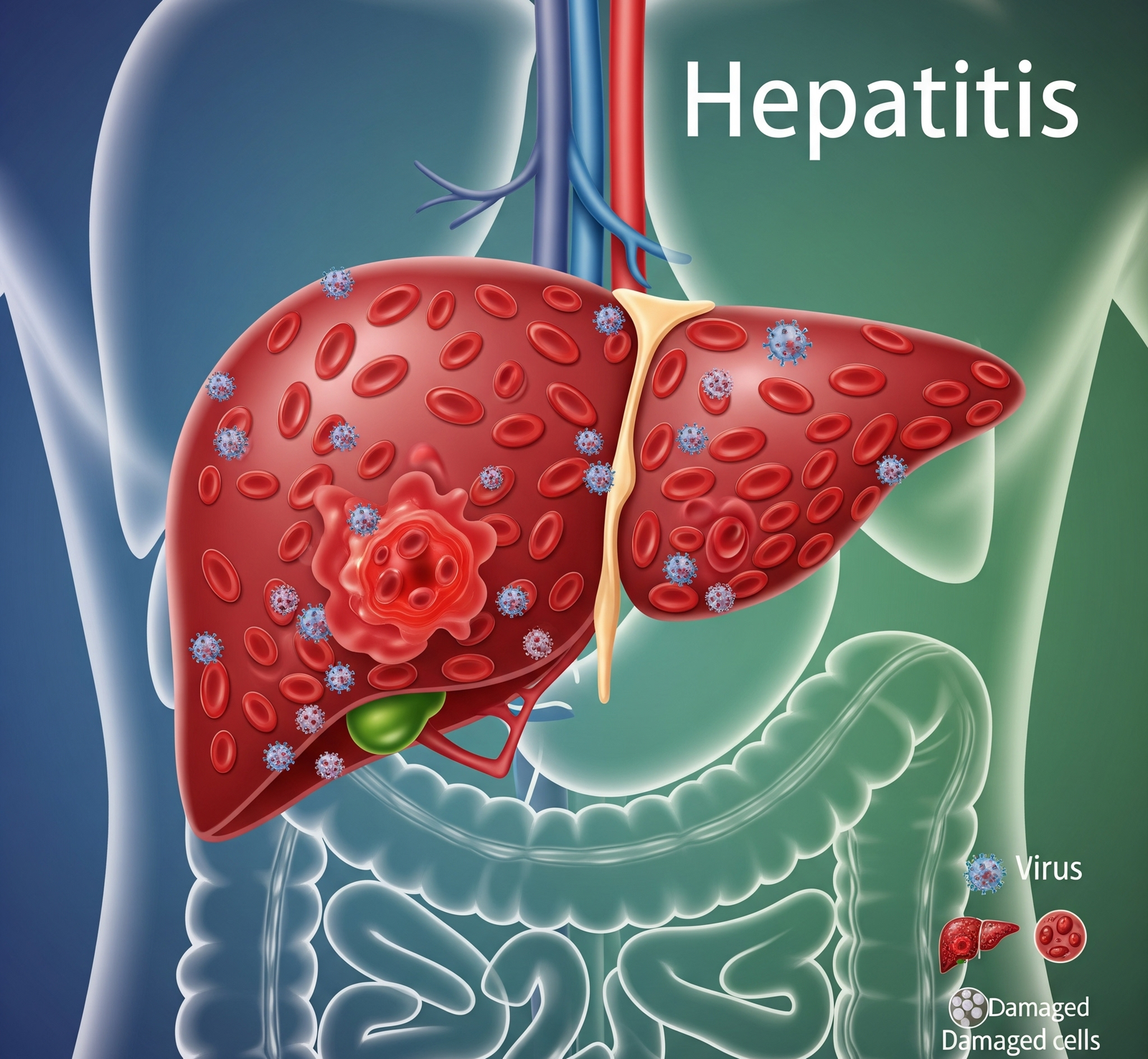 Comprendre l&rsquo;hépatite : symptômes, traitement et prévention